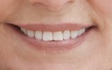 Chirurgia Implantare Guidata